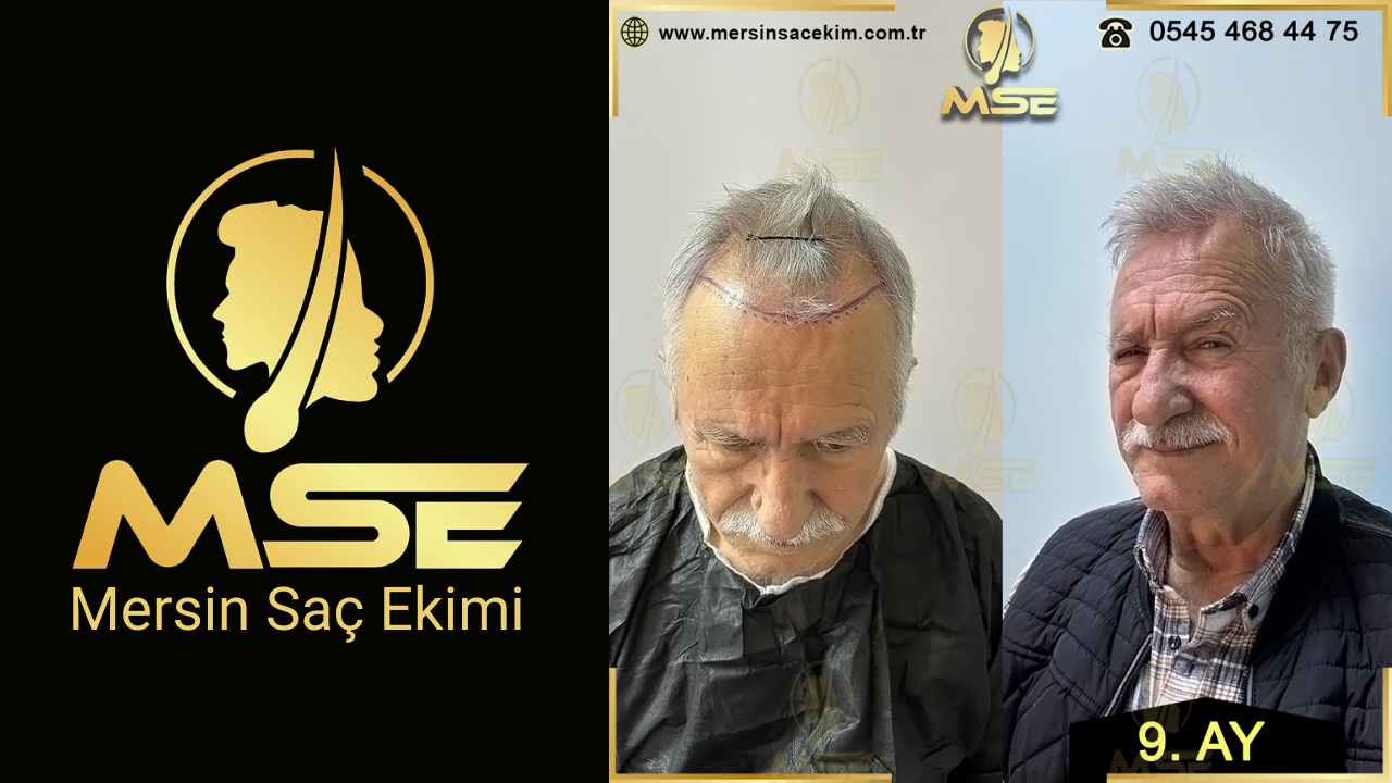 Mersin Saç Ekimi